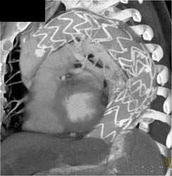 Endovascular Stent Repair of Arch Aneurysm - CTisus CT Scan