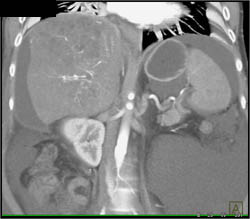 Hepatoma With Neovascularity - CTisus CT Scan