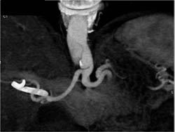 Focal Celiac Dissection - CTisus CT Scan