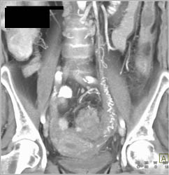 Dilated Ovarian Artery - CTisus CT Scan