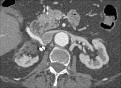 Renal Infarction With Bypass to Renal Artery - CTisus CT Scan