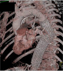 Endovascular Stent - CTisus CT Scan