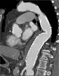 Endovascular Stent - CTisus CT Scan