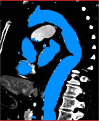 Endovascular Stent - CTisus CT Scan