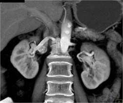 Patent Stent in Right Renal Artery - CTisus CT Scan