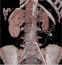 SFA Disease Bilaterally With Occlusion of the Left - CTisus CT Scan