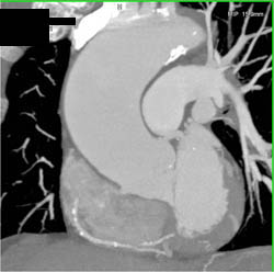 Pseudoaneurysm Off SFA - CTisus CT Scan