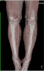 Bypass Grafts - CTisus CT Scan