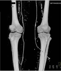 Bypass Grafts - CTisus CT Scan