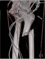 Femur Fracture Without Femoral Artery Injury - CTisus CT Scan