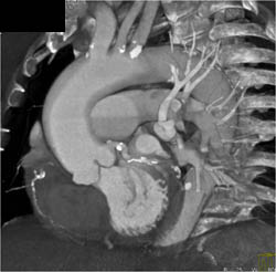 Dilated Sinuses of Valsalva - CTisus CT Scan