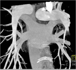 Pulmonary Vein Anatomy - CTisus CT Scan