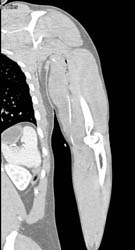 Stab Wound Shoulder With Brachial Artery Injury - CTisus CT Scan