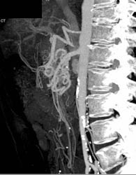 Median Arcuate Ligament Syndrome With Dilated Collaterals Through Gastroduodenal Artery (GDA) - CTisus CT Scan