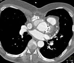 Pseudoaneurysm - CTisus CT Scan