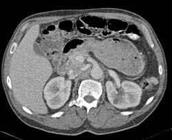 Renal Infarct - CTisus CT Scan