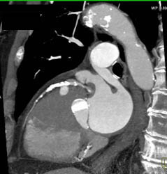 Diseased LAD - CTisus CT Scan