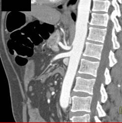 Clot in Branches of SMA - CTisus CT Scan