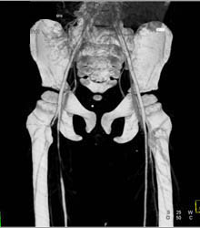 Narrowed Right SFA Due to Spasm S/P Trauma - CTisus CT Scan