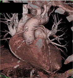 3 Venous Bypass Grafts - CTisus CT Scan