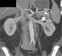 Renal Artery Aneurysm - CTisus CT Scan