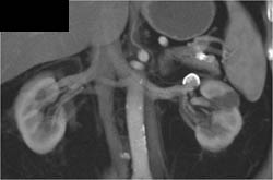 Renal Artery Aneurysm - CTisus CT Scan