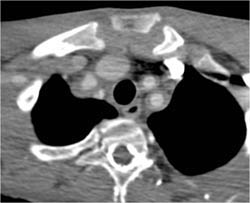 Takayasu's Arteritis - CTisus CT Scan