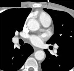 Dilated Left Main Coronary Artery in Takayasu's Arteritis - CTisus CT Scan