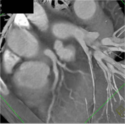 Irregular Left Main and LAD in Takayasu's Arteritis - CTisus CT Scan