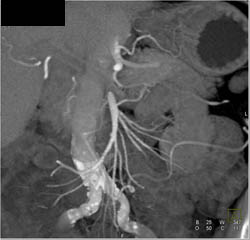 Occluded Proximal SMA - CTisus CT Scan