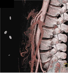 Small Caliber SMA and Celiac Axis and SMA Syndrome - CTisus CT Scan