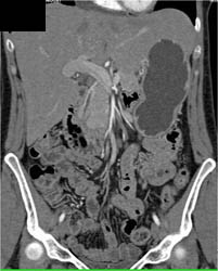 Pinched Left Renal Vein in Superior Mesenteric Artery (SMA) Syndrome - CTisus CT Scan