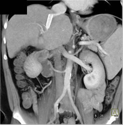 Transjugular Intrahepatic Portosystemic Shunt (TIPS) With Cirrhosis - CTisus CT Scan