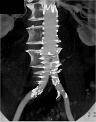 Endovascular Stent - CTisus CT Scan