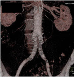 Endovascular Stent - CTisus CT Scan