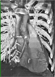 Dilated Proximal RCA at Re-anastomosis Site - CTisus CT Scan