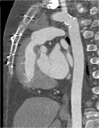 Coa Repair - CTisus CT Scan