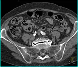 Narrowed Right Common and External Iliac Artery - CTisus CT Scan