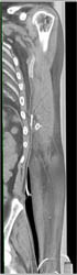 Patent Brachial and Radial Artery - CTisus CT Scan