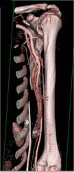 Av Fistulae - CTisus CT Scan