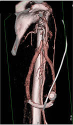 Av Fistulae - CTisus CT Scan