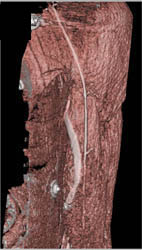 CTA With Bone Removal - CTisus CT Scan