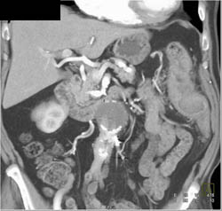 Endoleak - CTisus CT Scan