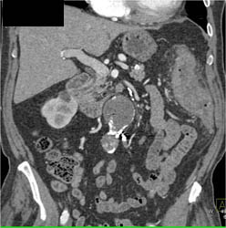 Endoleak - CTisus CT Scan