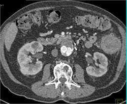 Endoleak - CTisus CT Scan