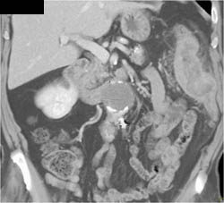 Endoleak - CTisus CT Scan