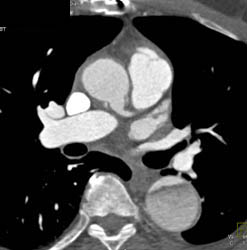 Aortic Dissection With Clot in Atrial Appendage - CTisus CT Scan