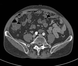 Iliac Occlusion - CTisus CT Scan