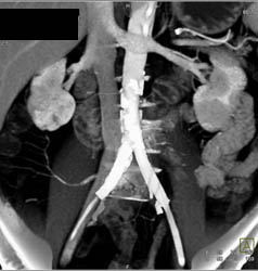 Patent Iliac Grafts - CTisus CT Scan