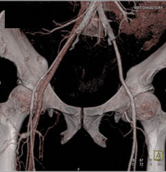 Patent Iliac Stents - CTisus CT Scan